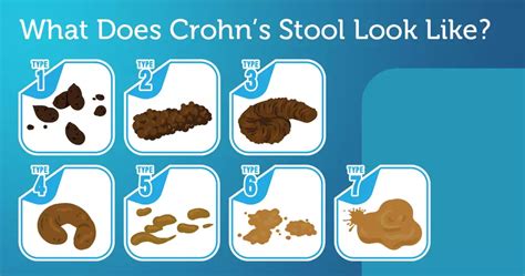 What Does Crohn’s Stool Look Like? | MyCrohnsAndColitisTeam