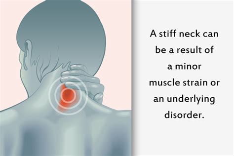 How to Get Rid of a Stiff Neck - eMediHealth