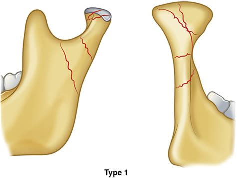 Figure 2 from Classification of Mandibular Condylar Fractures. | Semantic Scholar