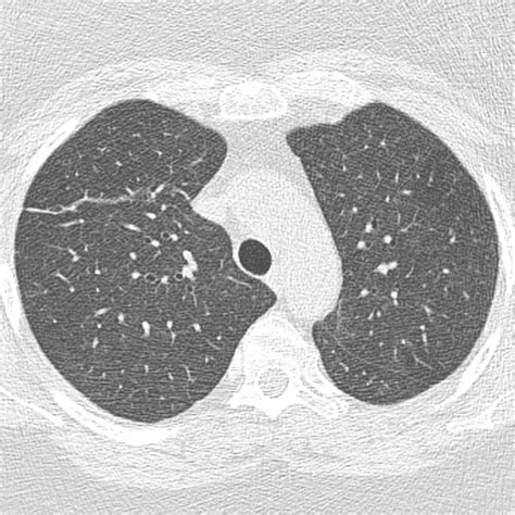 Bronchiolitis: A Practical Approach for the General Radiologist | RadioGraphics