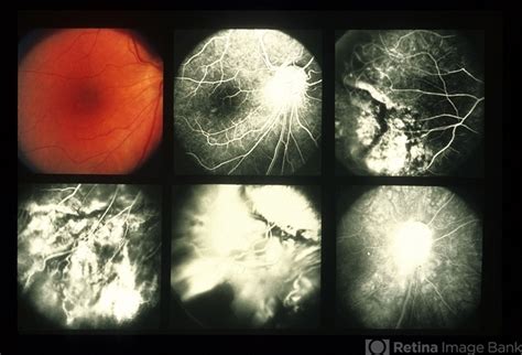 Eales Disease - Retina Image Bank