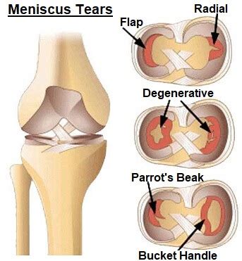 Knee Locking: Causes & Treatment For A Locked Knee - Knee Pain Exp