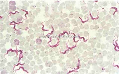 Trypanosomiasis Chagas’ disease Causes Diagnosis TREATMENT with Signs and Symptoms ...