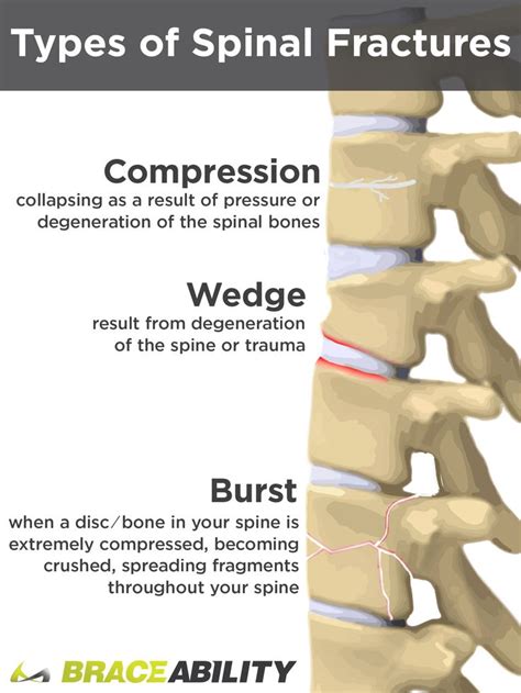 What Does it Mean If I’ve Been Diagnosed with a T12 or L1 Vertebral Burst Fracture? | Medical ...