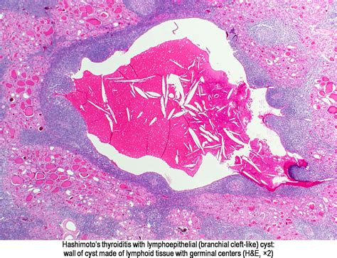 Pathology Outlines - Branchial pouch / cleft anomalies