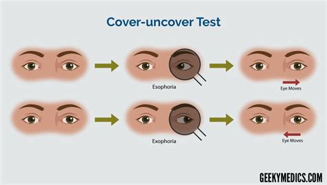 Strabismus | Exotropia - Esotropia | Cover test | Geeky Medics