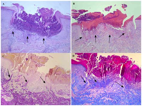 Clinical characteristics and prognosis of acquired perforating ...