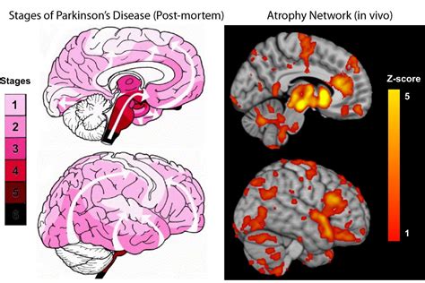 New study maps the progression of Parkinson’s disease within the brain | Montreal Neurological ...