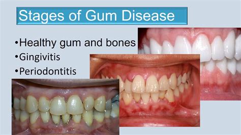 Stages of gum disease final edit 3 - YouTube