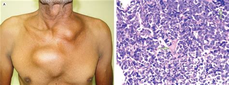 Multiple chest wall swellings in adult Burkitt's lymphoma - The Lancet