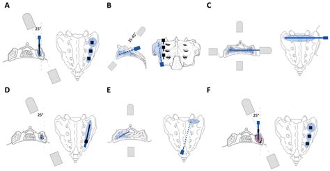 JCM | Free Full-Text | Sacroplasty for Sacral Insufficiency Fractures: Narrative Literature ...