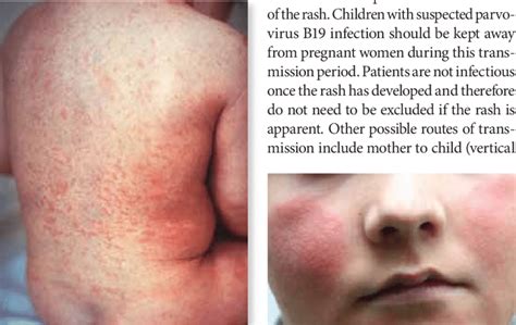 Rubella, or German measles. The maculopapular rash of rubella is ...