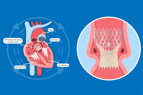 Earlier TAVR may be better for asymptomatic stenosis in presence of left ventricular hypertrophy ...