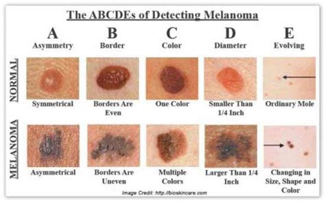 Melanoma Skin Cancer On Back