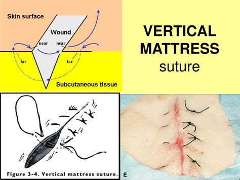 PPT - Suturing Basics PowerPoint Presentation, free download - ID:861706