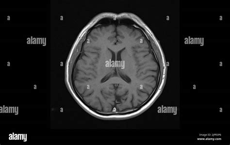 Healthy brain, MRI scan Stock Photo - Alamy