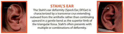 Stahl's Ear Correction East Longmeadow, MA - MA Plastic Surgery PLLC.