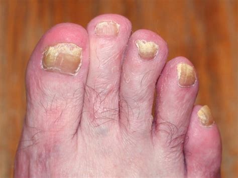 Toenail Fungus - Pictures, Symptoms, Causes, Treatment