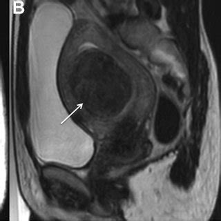 Sagittal T2-weighted MRI shows a comparison in size of one small ...