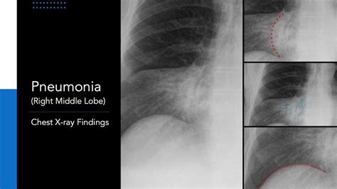 Pneumonia (Right Middle Lobe): Explanation of Chest X-ray Findings ...