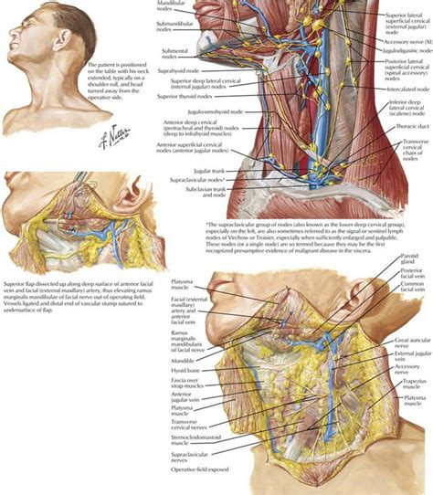 Selective (Supraomohyoid) Neck Dissection, Levels I-III | Basicmedical Key