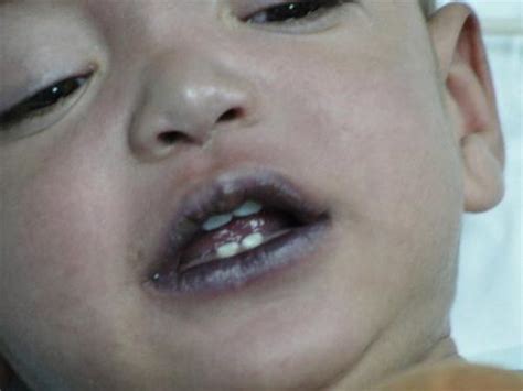 Pediatrics Notes: A Child Presenting With Cyanosis – Differential Diagnosis