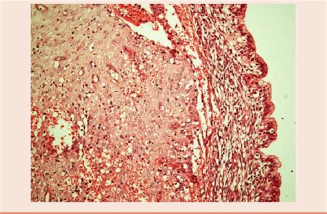 Photomicrograph showing endocervical mucosa lined tissue with presence ...