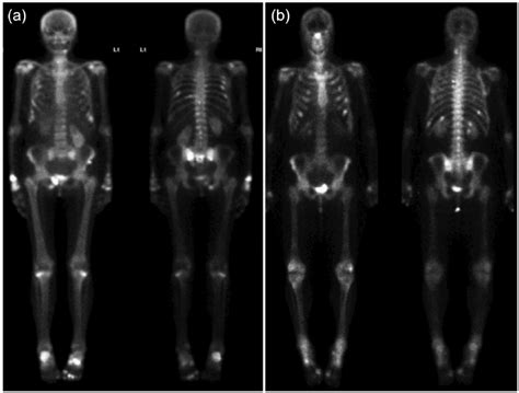 Radioisotope whole-body bone scan. (a) Increased focal uptake ...