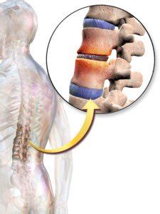 Extruded or Herniated Disc: Long Term Effects » Scary Symptoms