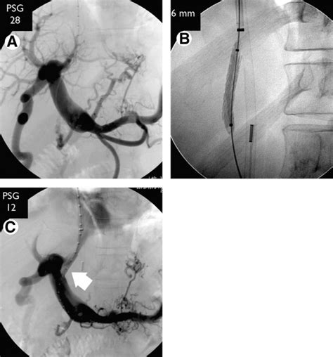 Direct Intrahepatic Portocaval Shunt - Techniques in Vascular ...