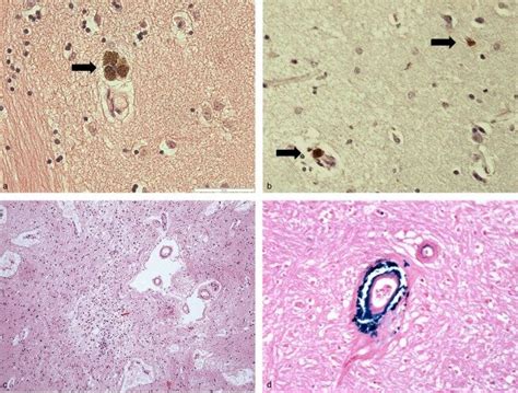 Haemosiderin deposits. Grouped clusters of several profiles (a; arrow)... | Download Scientific ...