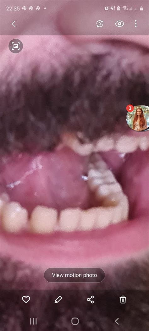 Pain after dental crown procedure : Dentistry