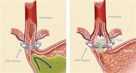 GERD - LINX System Specialist - Beverly Hills Los Angeles, CA ...