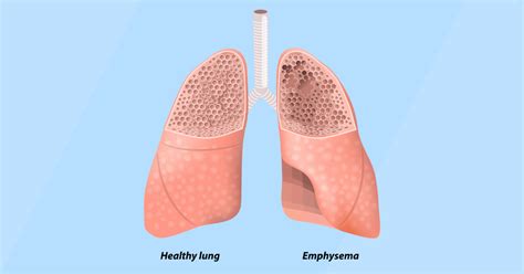 Lung Health Institute What Is Emphysema And What Does It