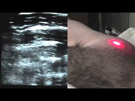 Ultrasound Guided PECS Block - SSRAUSA.com - YouTube