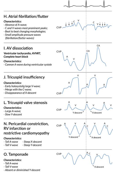 Analysis Of Central Venous Pressure (CVP) Signals Using, 49% OFF