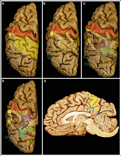 Superior Parietal Lobule Approach