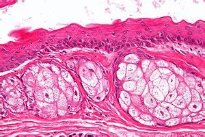 Steatocystoma - Libre Pathology