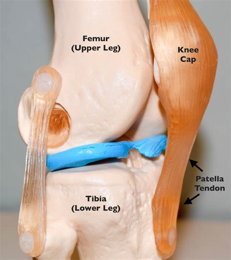 Chronic Patella Tendinopathy