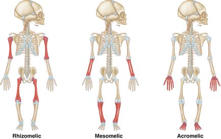 Skeletal Dysplasia | Musculoskeletal Key