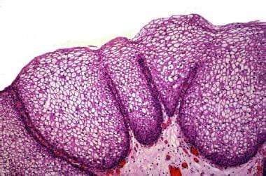 Trigonitis Workup: Approach Considerations, Procedures, Histologic Findings