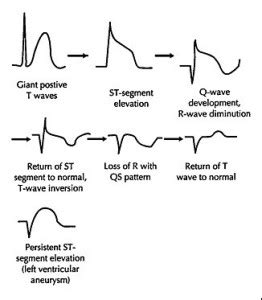 emDOCs.net – Emergency Medicine EducationSubtle ECG findings in ACS: Part II Hyperacute T-Waves ...