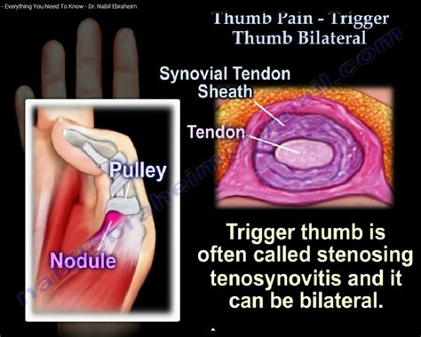 Trigger Thumb Basics — OrthopaedicPrinciples.com