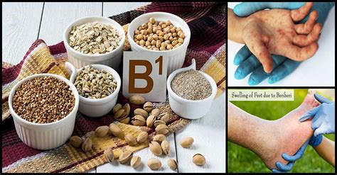 Effective Treatments And Natural Remedies For Beriberi | Dr Farrah MD