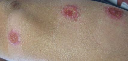 Erythematous Seropurulent Ulcerations | MDedge Dermatology