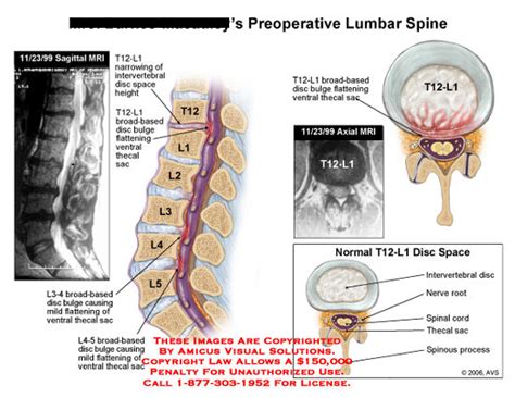 AMICUS Illustration of amicus,injury,lumbar,disc,bulge,thecal,thecal,sac,sagittal,axial,T12-L1