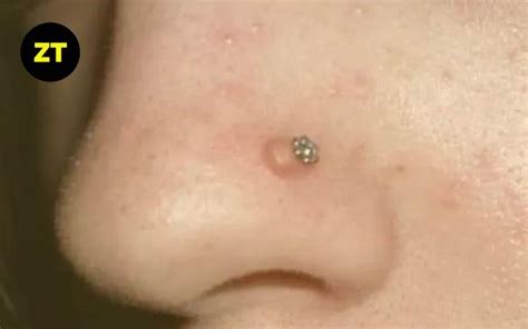 Hypertrophic Scar On Nose Piercing | Guide