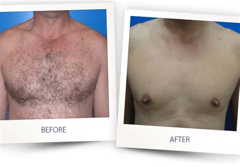 Permanent full body laser hair removal for men in Toronto - VS MedSpa