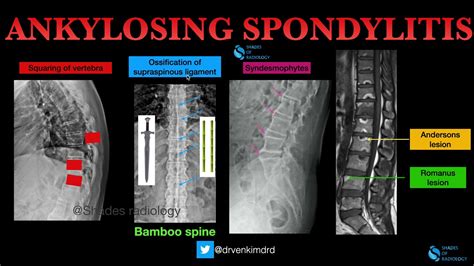 Ankylosing Spondylitis- Classic Imaging features - YouTube