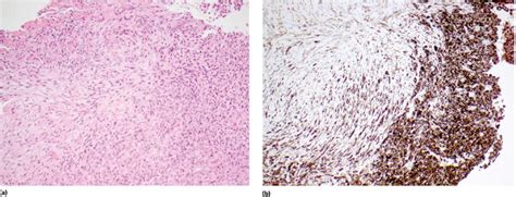 5: Pleural Pathology | Thoracic Key